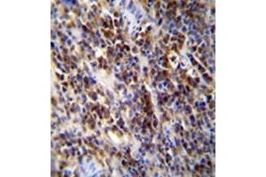 Immunohistochemistry analysis in formalin fixed and paraffin embedded human lymphoma reacted with PAPR9 Antibody (C-term) followed which was peroxidase conjugated to the secondary antibody followed byand DAB staining. (PARP9 Antikörper  (C-Term))