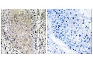 Immunohistochemistry analysis of paraffin-embedded human lung carcinoma tissue using CBLN3 antibody. (CBLN3 Antikörper  (C-Term))
