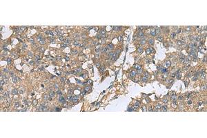 Immunohistochemistry of paraffin-embedded Human liver cancer tissue using EIF1AX Polyclonal Antibody at dilution of 1:65(x200) (EIF1AX Antikörper)