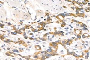 Immunohistochemistry analysis of paraffin-embedded human stomach cancer using MRPL12 (ABIN7074638) at dilution of 1: 1000 (MRPL12 Antikörper)