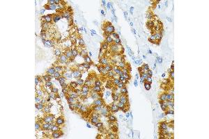 Immunohistochemistry of paraffin-embedded human liver cancer using B3 Rabbit mAb (ABIN7265774) at dilution of 1:100 (40x lens). (ATP1B3 Antikörper)