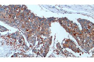 Detection of CTSD in Human Liver cancer Tissue using Monoclonal Antibody to Cathepsin D (CTSD) (Cathepsin D Antikörper  (AA 21-412))