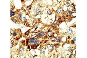 IHC analysis of FFPE human hepatocarcinoma stained with the Dnmt3a antibody (DNMT3A Antikörper  (AA 457-486))
