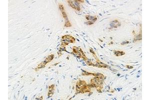 ABIN6262841 and ABIN6274094 at 1/100 staining human pancreatic carcinoma by IHC-P. (KLF11 Antikörper  (N-Term))