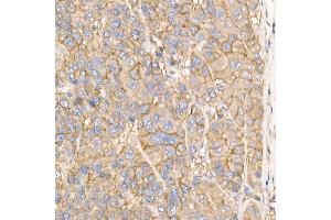 Immunohistochemistry of paraffin-embedded human liver cancer using Na+/K+-ATPase Rabbit pAb (ABIN6133568, ABIN6137299, ABIN6137301 and ABIN6223860) at dilution of 1:50 (40x lens). (ATP1A1 Antikörper  (AA 1-100))
