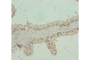 Immunohistochemistry of paraffin-embedded human prostate cancer using ABIN7151192 at dilution of 1:100 (RNF34 Antikörper  (AA 1-220))