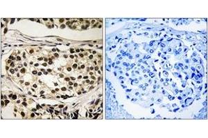 Immunohistochemistry analysis of paraffin-embedded human breast carcinoma, using Cyclin C (Phospho-Ser275) Antibody. (Cyclin C Antikörper  (pSer275))