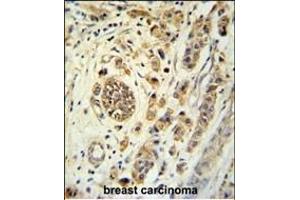 FBXL15 Antibody (C-term) (ABIN651414 and ABIN2840224) immunohistochemistry analysis in formalin fixed and paraffin embedded human breast carcinoma followed by peroxidase conjugation of the secondary antibody and DAB staining. (FBXL15 Antikörper  (C-Term))