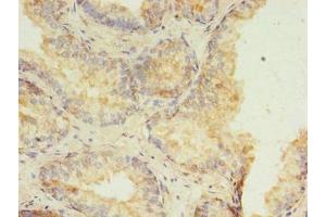 Immunohistochemistry of paraffin-embedded human prostate cancer using ABIN7155196 at dilution of 1:100 (HMGN3 Antikörper  (AA 1-77))
