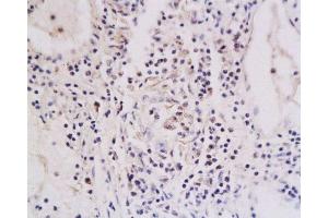 Formalin-fixed and paraffin embedded human oral squamous cell carcinoma labeled with Anti-TNFRSF18 Polyclonal Antibody , Unconjugated at 1:200, followed by conjugation to the secondary antibody and DAB staining (TNFRSF18 Antikörper  (AA 201-274))