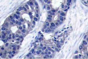 Immunohistochemistry analysis of human breast carcinoma tissue (Formalin-fixed, Paraffin-embedded) using IRS1 antibody . (IRS1 Antikörper)