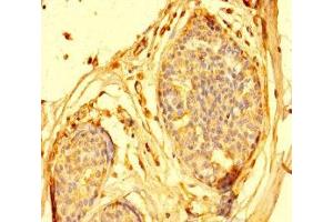 Immunohistochemistry of paraffin-embedded human breast cancer using ABIN7144032 at dilution of 1:100 (AMIGO1 Antikörper  (AA 28-327))