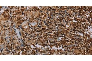 Immunohistochemistry of paraffin-embedded Human thyroid cancer using TBX5 Polyclonal Antibody at dilution of 1:35 (T-Box 5 Antikörper)