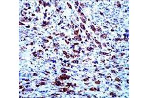 Immunohistochemical staining of APOA5 on paraffin-embedded human anaplastic lymphoma with APOA5 monoclonal antibody, clone 1G5G9 .