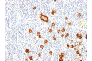 Formalin-fixed, paraffin-embedded human Hodgkin's Lymphoma stained with CD15 Mouse Monoclonal Antibody (FUT4/815). (CD15 Antikörper)