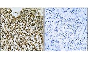 Immunohistochemistry analysis of paraffin-embedded human breast carcinoma tissue, using RPC5 Antibody.