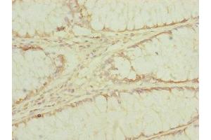 Immunohistochemistry of paraffin-embedded human colon cancer using ABIN7151546 at dilution of 1:100 (EEF1G Antikörper  (AA 168-437))