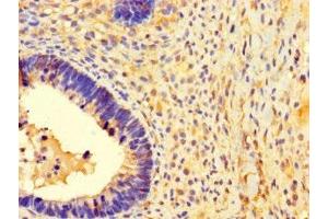Immunohistochemistry of paraffin-embedded human ovarian cancer using ABIN7142435 at dilution of 1:100 (MRPL39 Antikörper  (AA 1-158))