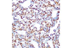 Immunohistochemistry of paraffin-embedded human liver cancer using T Rabbit pAb (ABIN7270794) at dilution of 1:100 (40x lens). (TAB3 Antikörper)