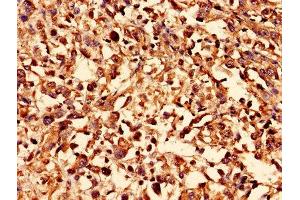 Immunohistochemistry analysis of human melanoma using ABIN7170123 at dilution of 1:100 (GLUT4 Antikörper  (AA 223-287))