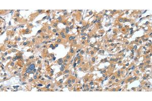 Immunohistochemistry of paraffin-embedded Human thyroid cancer tissue using DSC1 Polyclonal Antibody at dilution 1:40 (Desmocollin 1 Antikörper)