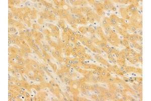 ABIN6257703 and ABIN6273923 at 1/100 staining human hepatocellular carcinoma by IHC-P. (CCKBR Antikörper  (N-Term))