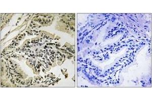Immunohistochemistry analysis of paraffin-embedded human prostate carcinoma, using PEK/PERK (Phospho-Thr981) Antibody. (PERK Antikörper  (pThr981))