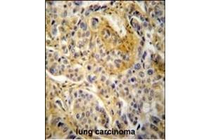 NCF1 Antibody (N-term) (ABIN652063 and ABIN2840531) immunohistochemistry analysis in formalin fixed and paraffin embedded human lung carcinoma followed by peroxidase conjugation of the secondary antibody and DAB staining. (NCF1 Antikörper  (N-Term))