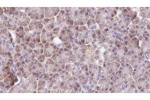 ABIN6273230 at 1/100 staining Human pancreas cancer tissue by IHC-P. (DDC Antikörper  (Internal Region))
