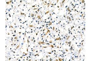Phospho-Lamin A/C (Ser390) Antibody at 1/100 staining Human ovarian cancer and adjacent normal tissues by IHC-P.