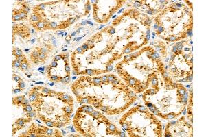 ABIN6257428 and ABIN6275868 at 1/100 staining Human kidney cancer and adjacent normal tissues by IHC-P. (CD90 Antikörper  (Internal Region))