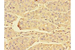 Immunohistochemistry of paraffin-embedded human liver cancer using ABIN7172023 at dilution of 1:100 (Peroxiredoxin 3 Antikörper  (AA 63-256))