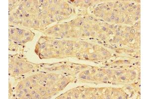 Immunohistochemistry of paraffin-embedded human liver cancer using ABIN7172023 at dilution of 1:100 (Peroxiredoxin 3 Antikörper  (AA 63-256))