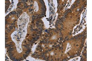The image on the left is immunohistochemistry of paraffin-embedded Human colon cancer tissue using ABIN7129488(FGF18 Antibody) at dilution 1/20, on the right is treated with fusion protein. (FGF18 Antikörper)