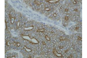 Detection of cytokeratin on paraffin-embedded sections of guinea pig breast carcinoma using anti-cytokeratin antibody (pan Keratin Antikörper)