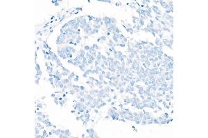 Immunohistochemistry (IHC) image for anti-NK2 Homeobox 1 (NKX2-1) antibody (ABIN1679475)