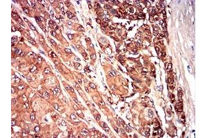 Immunohistochemical analysis of paraffin-embedded liver cancer tissues using SAA1 mouse mAb with DAB staining. (SAA1 Antikörper  (AA 19-212))