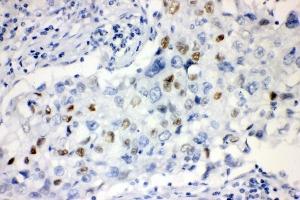 IHC analysis of CCNE1 using anti-CCNE1 antibody (ABIN7601193). (Cyclin E1 Antikörper  (AA 3-386))