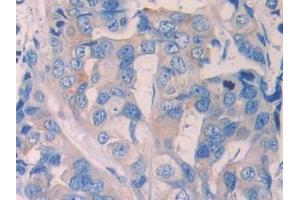 Detection of RNLS in Human Breast cancer Tissue using Polyclonal Antibody to Renalase (RNLS) (RNLS Antikörper  (AA 160-319))