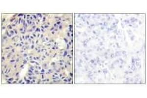 Immunohistochemistry analysis of paraffin-embedded human breast carcinoma tissue using Collagen V α2 antibody.