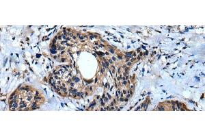 Immunohistochemistry of paraffin-embedded Human cervical cancer tissue using IQGAP1 Polyclonal Antibody at dilution of 1:30(x200) (IQGAP1 Antikörper)