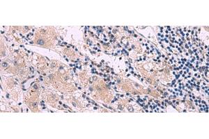 Immunohistochemistry of paraffin-embedded Human liver cancer tissue using NMRK2 Polyclonal Antibody at dilution of 1:55(x200) (ITGB1BP3 Antikörper)