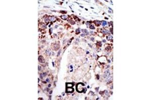 Formalin-fixed and paraffin-embedded human cancer tissue reacted with the primary antibody, which was peroxidase-conjugated to the secondary antibody, followed by AEC staining. (Ataxin 3 Antikörper  (N-Term))