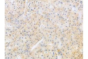 ABIN6266031 and ABIN6269398 at 1/100 staining human hepatocellular carcinoma by IHC-P. (WNK1 Antikörper  (N-Term))