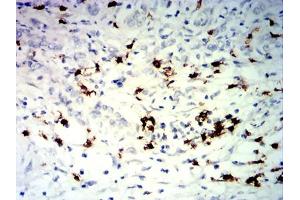 Immunohistochemical analysis of paraffin-embedded stomach cancer tissues using TNFRSF25 mouse mAb with DAB staining. (DR3/LARD Antikörper)