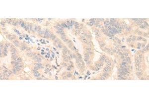Immunohistochemistry of paraffin-embedded Human thyroid cancer tissue using HMBS Polyclonal Antibody at dilution of 1:25(x200) (HMBS Antikörper)