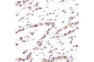 Immunohistochemistry of paraffin-embedded human colon carcinoma using TriMethyl-Histone H3-K27 antibody (ABIN7267698) at dilution of 1:25 (40x lens).