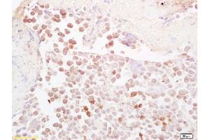 Formalin-fixed and paraffin embedded mouse colon carcinoma labeled with Anti-NQO1 Polyclonal Antibody, Unconjugated (ABIN678428) at 1:200, followed by conjugation to the secondary antibody and DAB staining (NQO1 Antikörper  (AA 201-274))