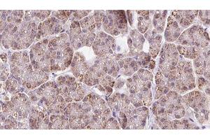 ABIN6273243 at 1/100 staining Human pancreas cancer tissue by IHC-P. (FBXO22 Antikörper  (Internal Region))
