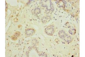 Immunohistochemistry of paraffin-embedded human breast cancer using ABIN7165622 at dilution of 1:100 (C17orf66 Antikörper  (AA 1-219))